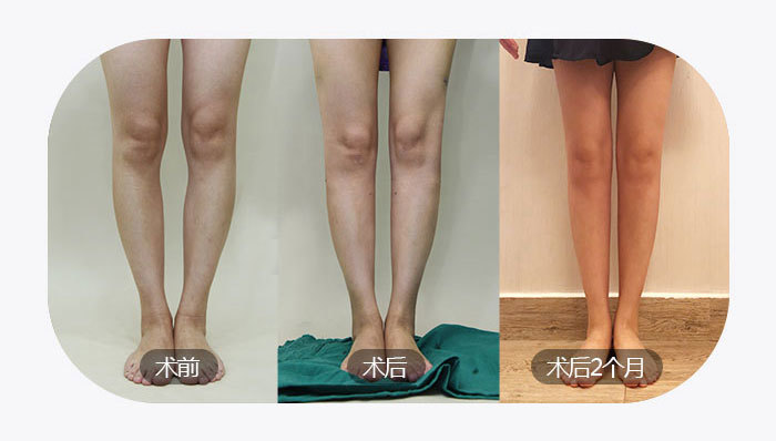 ox型腿矫正看似简单,其实对医生的技术和经验要求非_圈子-新氧美容