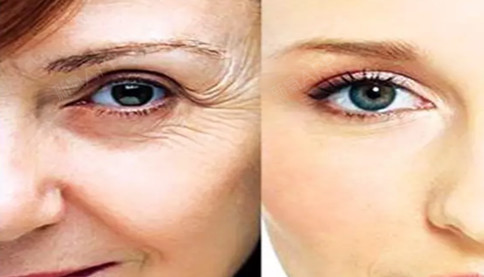 聊聊面部拉皮手术祛皱多久恢复自然?