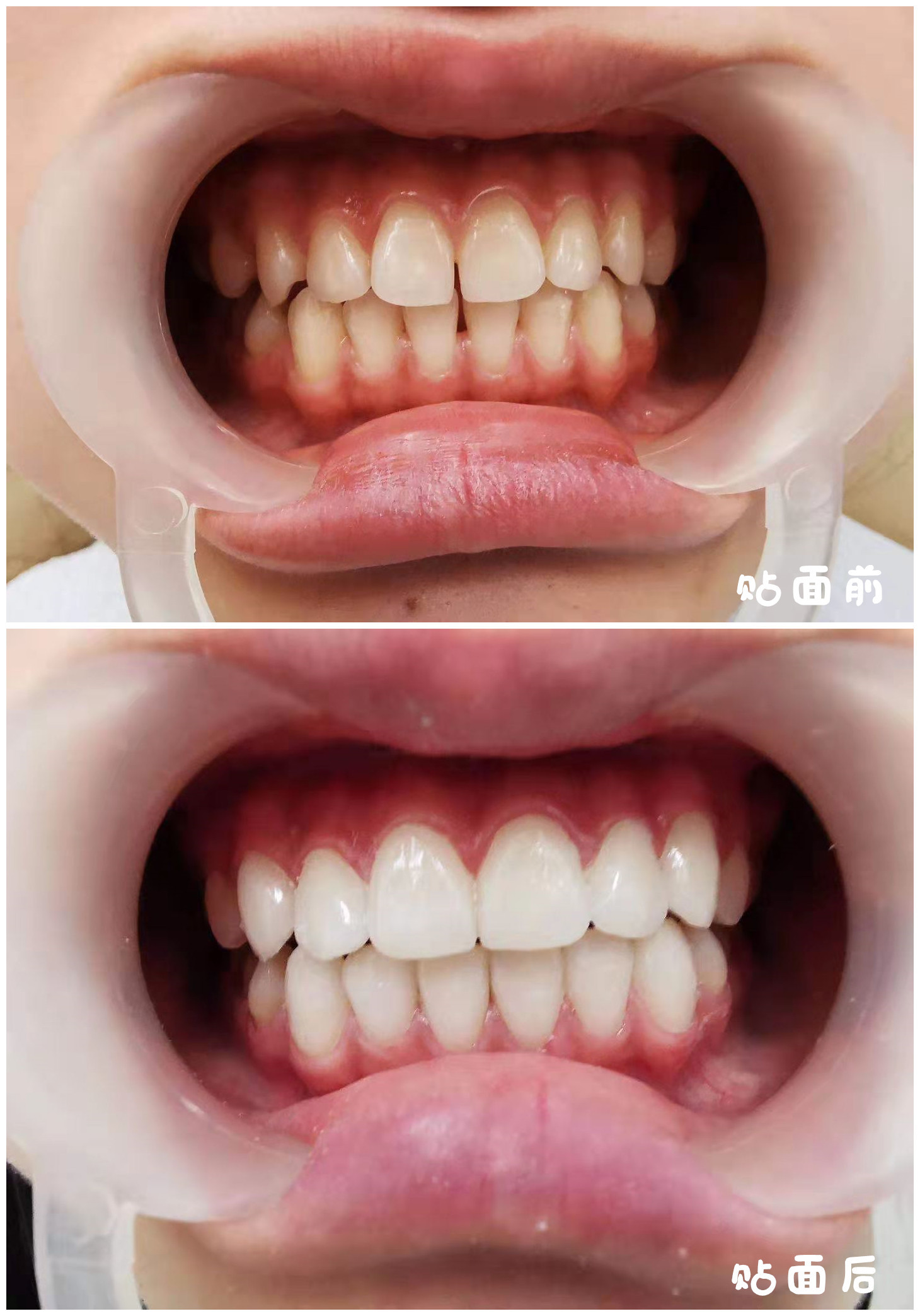 97 牙齿贴面可能很多_圈子-新氧美容整形