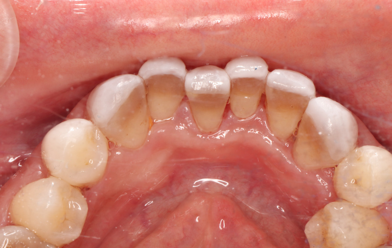 有一口好牙太重要了一招让你拥有一口好牙