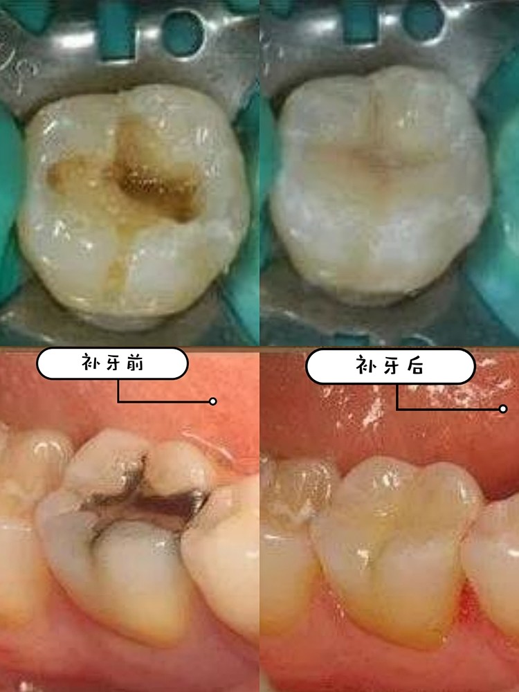 有龋齿不痛,也需要补牙治疗!