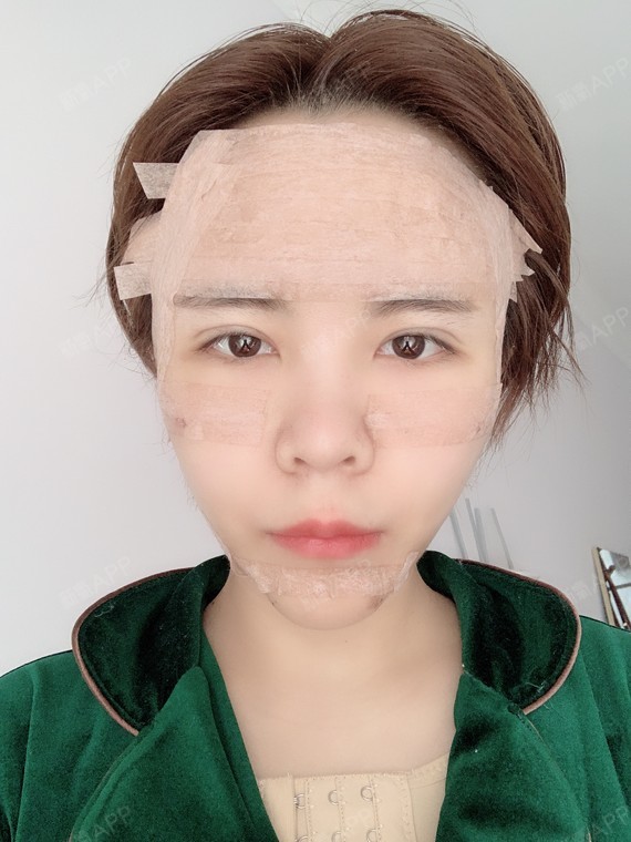 项目:自体脂肪全脸填充