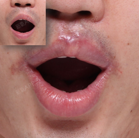 唇腭裂手术好不好_效果图_唇腭裂手术术后第12天_新氧美容整形