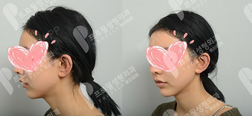 贴发耳矫正整个案例经过先到                    医院在线