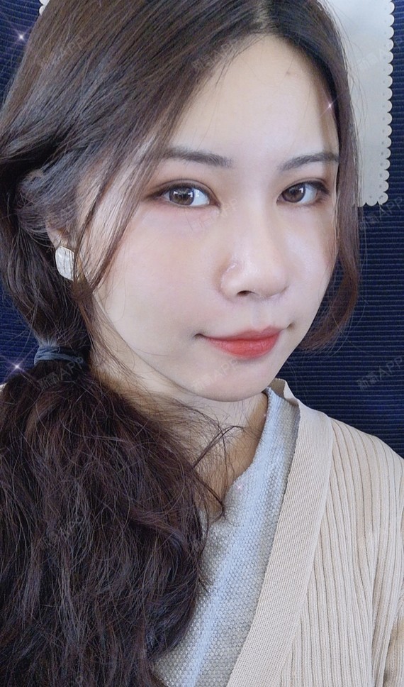 自体脂肪填充面部吸脂术后第7天