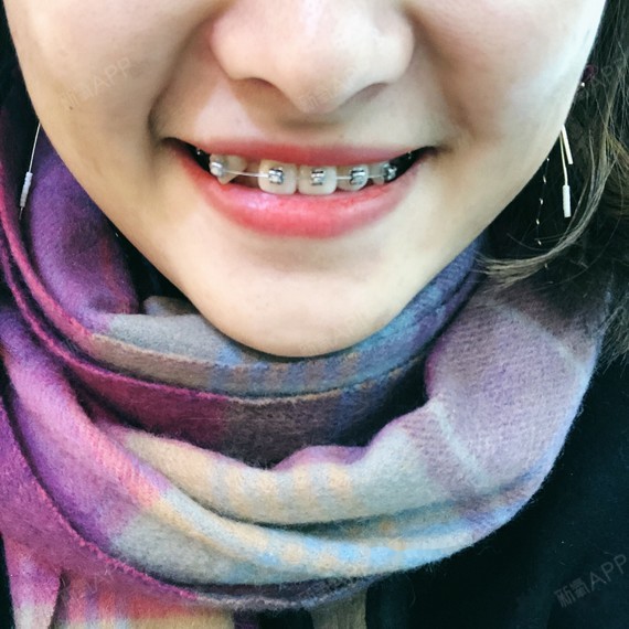 我今年22岁 大四 至于为什么这么晚才开始矫正有两_圈子-新氧美容整形