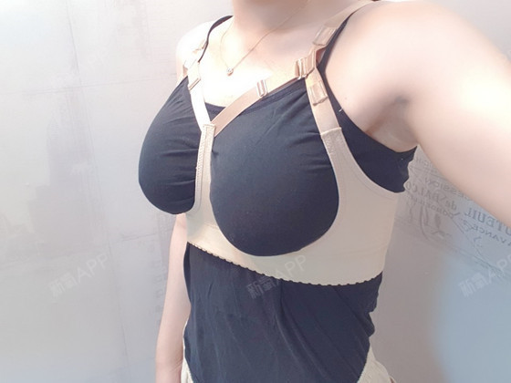 假体隆胸好不好_效果图_氧气3p6u6假体隆胸术后第8天_新氧美容整形