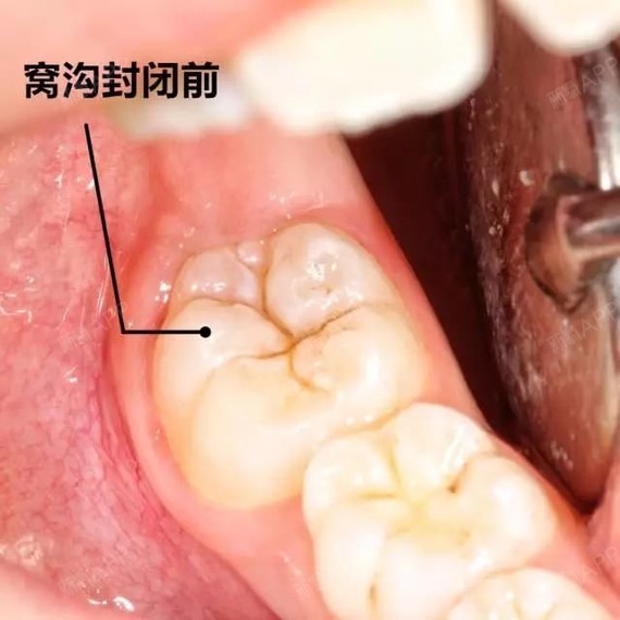 第二乳磨牙图片图片