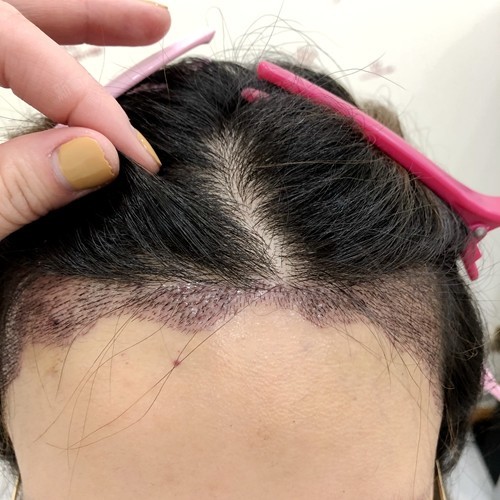 来给大家展示一下植发成果波浪形的发际线