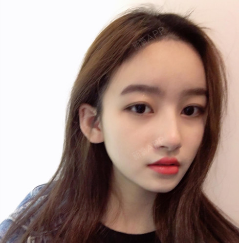 福州耳软骨复合隆鼻好不好_效果图_吃药药药耳软骨复合隆鼻术后第117