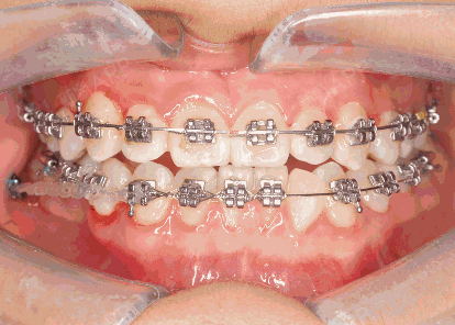 简单来说,牙齿矫正是通过利用一个破坏与再生的机制影响牙槽骨,对牙齿