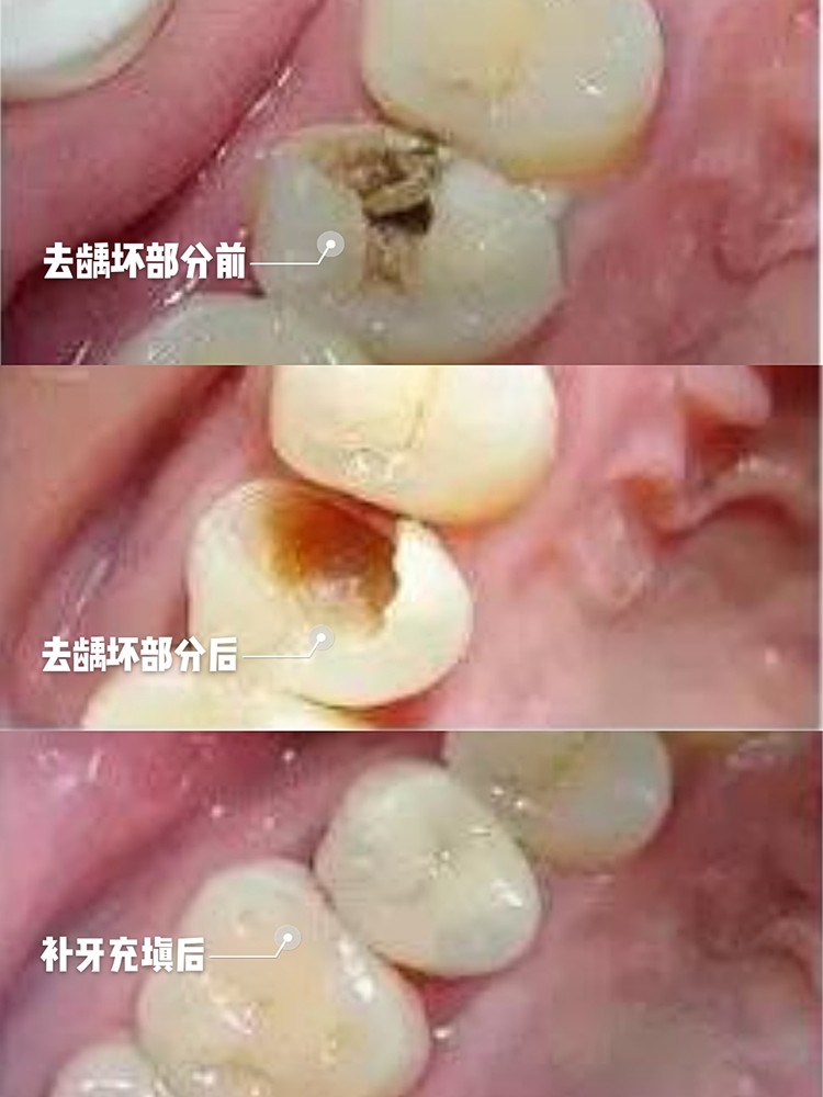 龋齿坏到什么程度需做根管治疗 简单来说 牙齿龋坏 圈子 新氧美容整形