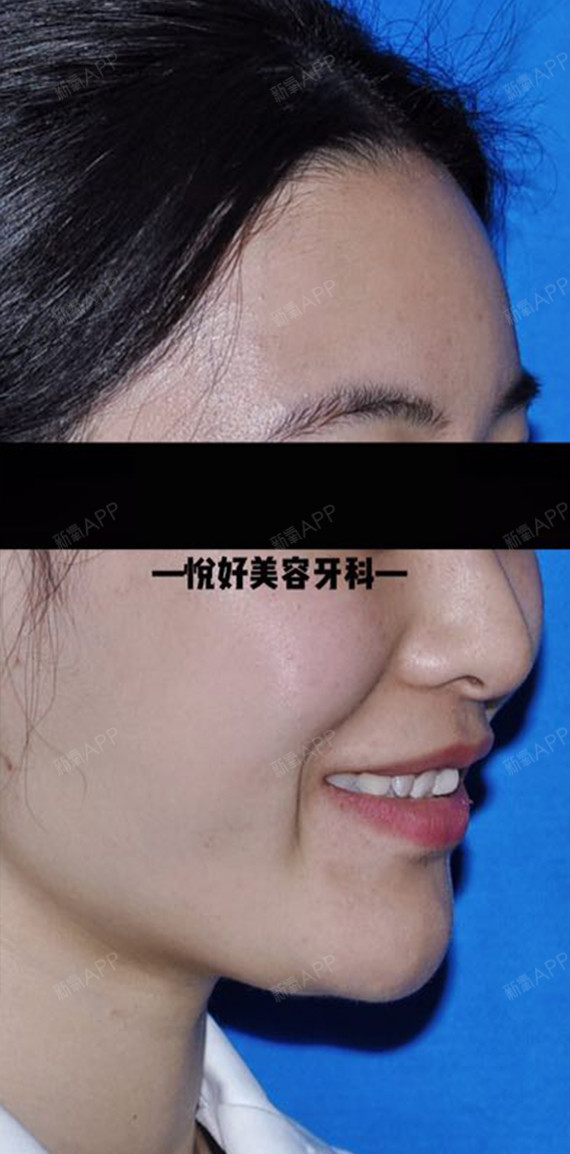 门牙不好看,咬合不齐,牙齿做了可以改变整个脸型,为_圈子-新氧美容