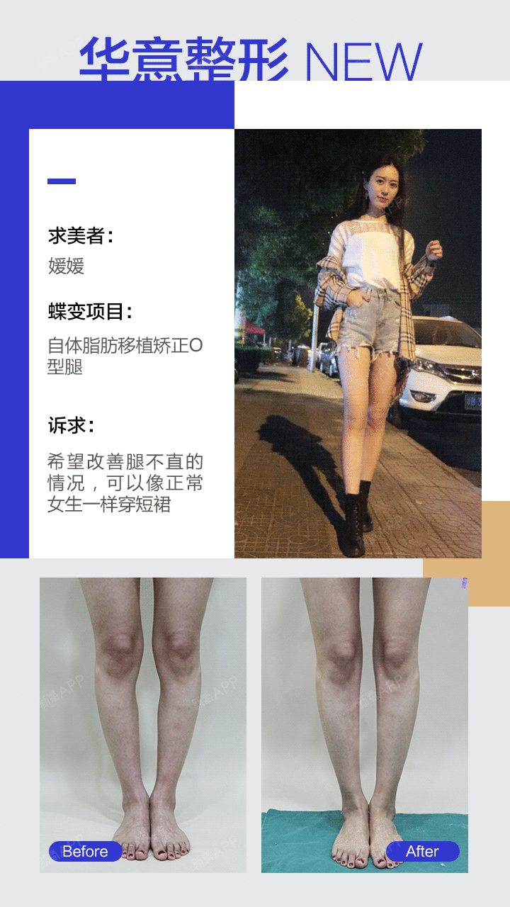 可以用于矫正大腿内侧凹陷,大腿外侧凸出,膝关节内侧凸出,膝关节外侧