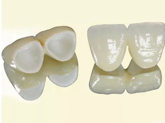 全瓷牙,让你从此摆脱牙龈黑线