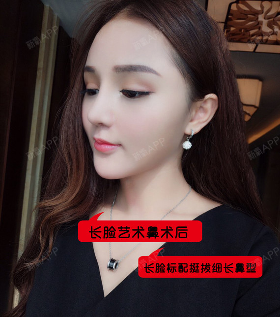 隆鼻自查表看脸型选鼻型拒绝撞脸