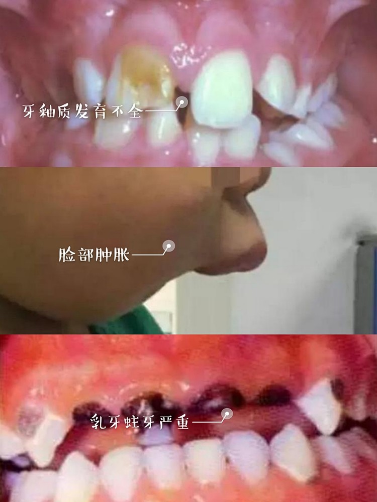 乳牙蛀牙严重,但是牙不疼,需要治疗吗?