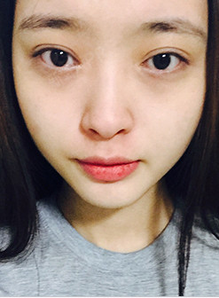 术前 山根很低 整个人的面部很平 五官没有特色