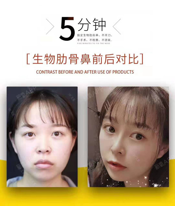 licol葡聚糖打造鱼形生物肋骨鼻,山根,鼻背,鼻_圈子-新氧美容整形