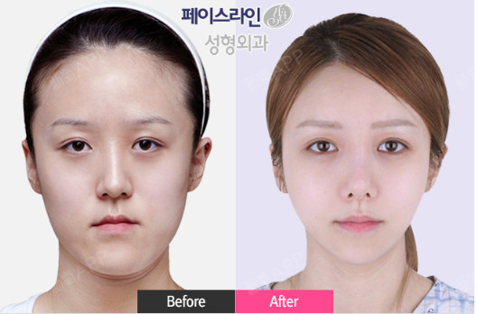 首页 此页面仅支持预览 Avatar Yuki 吕 79篇日记 韩国菲斯莱茵的双颚手术优势是什么 效果怎么样 双颚手术是一个大手术 所以对于医院院长的技术 手术经验要求特别高 很多宝宝们很纠结 也一直在做功课 不知道到底应该怎么选择 听身边人经常说菲