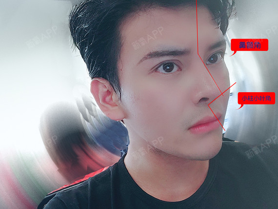 男士隆鼻注意了,这样做才能避免"娘娘腔"!