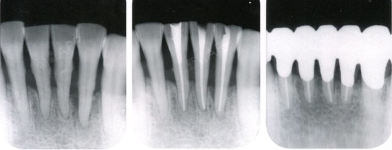 教科书上对理想根管充填的定义为:根尖片中根管充填材料到达的垂直
