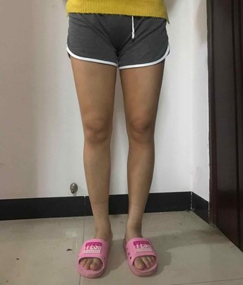 合集·吸脂瘦大腿 吸脂瘦小腿 .