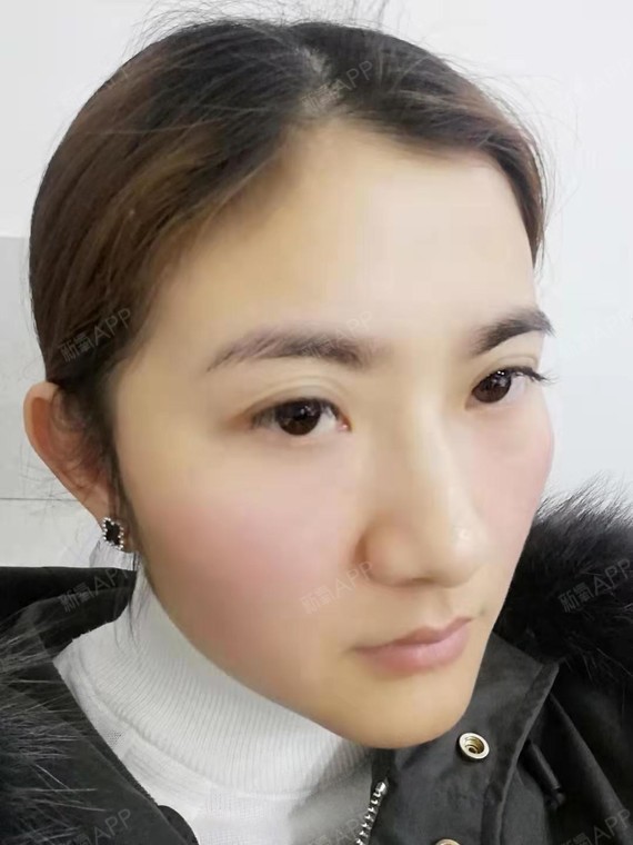 【芜湖瑞丽医疗美容 内吸祛眼袋 术后32天】眼袋做_圈子-新氧美容整形