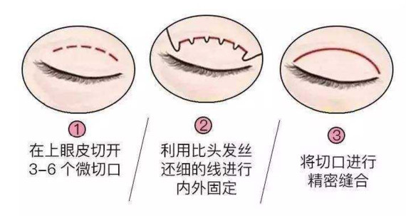 然而,埋线双眼皮手术,植入的是蛋白线体,会被人体吸收,术后并不用去