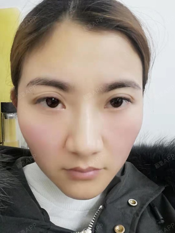 【芜湖瑞丽医疗美容 内吸祛眼袋 术后32天】眼袋做_圈子-新氧美容整形