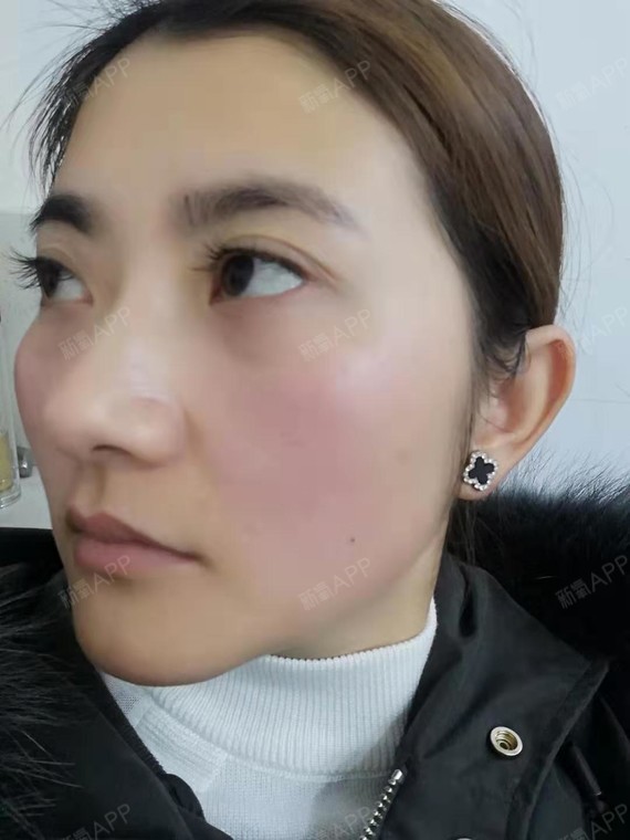 【芜湖瑞丽医疗美容 内吸祛眼袋 术后32天】眼袋做_圈子-新氧美容整形