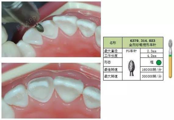 4mm,工作長度10mm,粗顆粒)製備舌側軸面,均勻磨除約1mm的牙體.