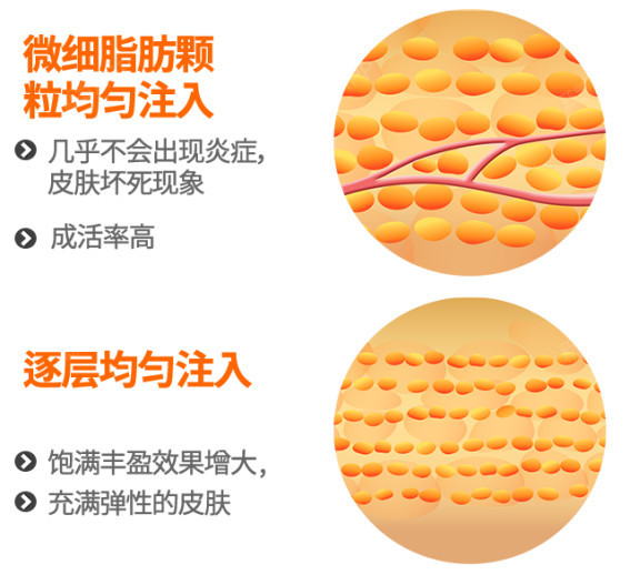 填充脂肪能维持多久_填充脂肪后有硬块怎么消除_填充自己的脂肪