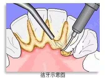 洗牙——健康省錢的投資隨著口腔健康越來越被人們重視,身邊人補牙