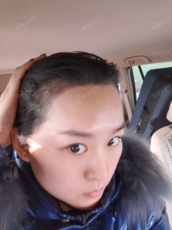 半永久纹发际线好不好_效果图_氧气7rn713b半永久纹发际线术后第6天