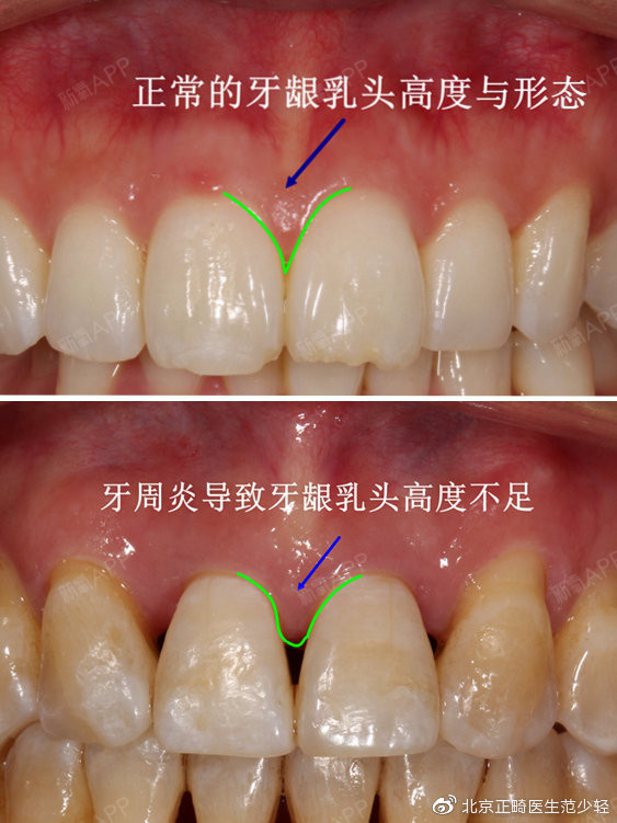 什么是 牙龈黑三角?可以预防吗?可以消除吗?