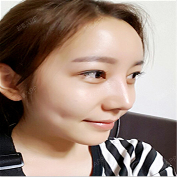 之前有点鹰勾鼻的时候,一点也不敢相信自己会有这么软_圈子-新氧美容