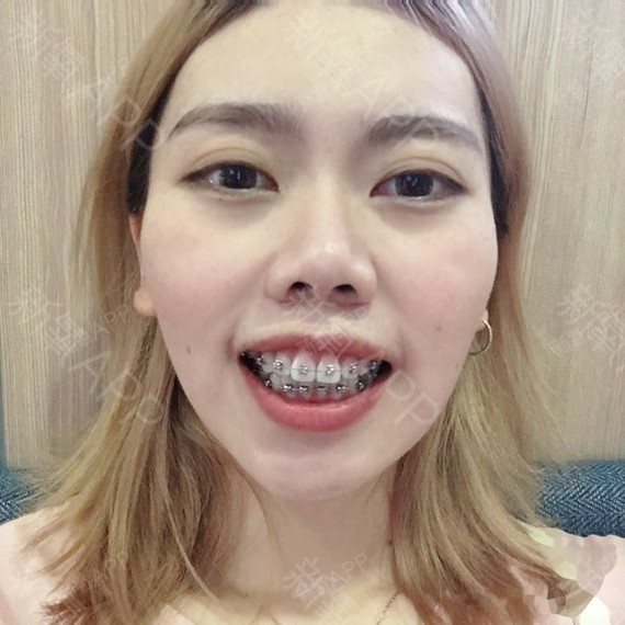 在做烤瓷牙时,很多人一肚子气