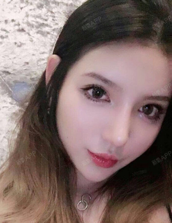 我的做的是肋骨鼻哦~,之所以选择半肋骨隆鼻是因为半_圈子-新氧美容