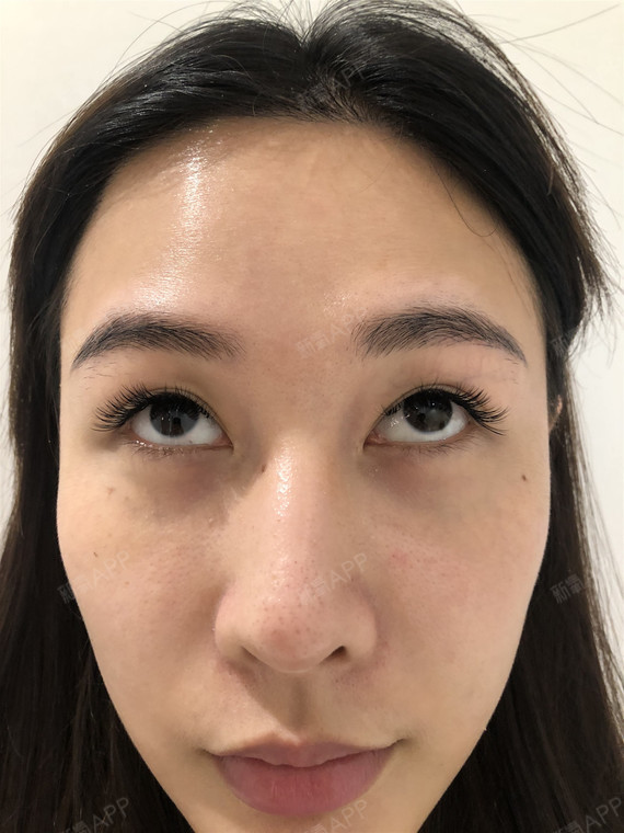 泪沟是由内眼角开始出现在下眼睑靠鼻侧的一条凹沟,泪_圈子-新氧美容