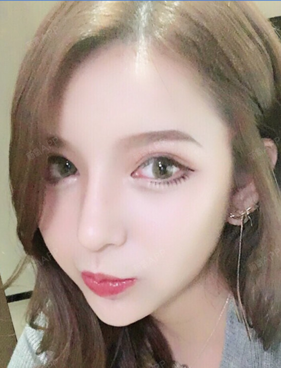 我的做的是肋骨鼻哦~,之所以选择半肋骨隆鼻是因为半_圈子-新氧美容