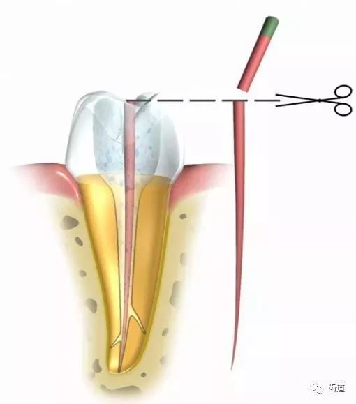 区域,包括冠方,根尖孔,侧副根管,根尖分歧及根管内的各个不规则区域