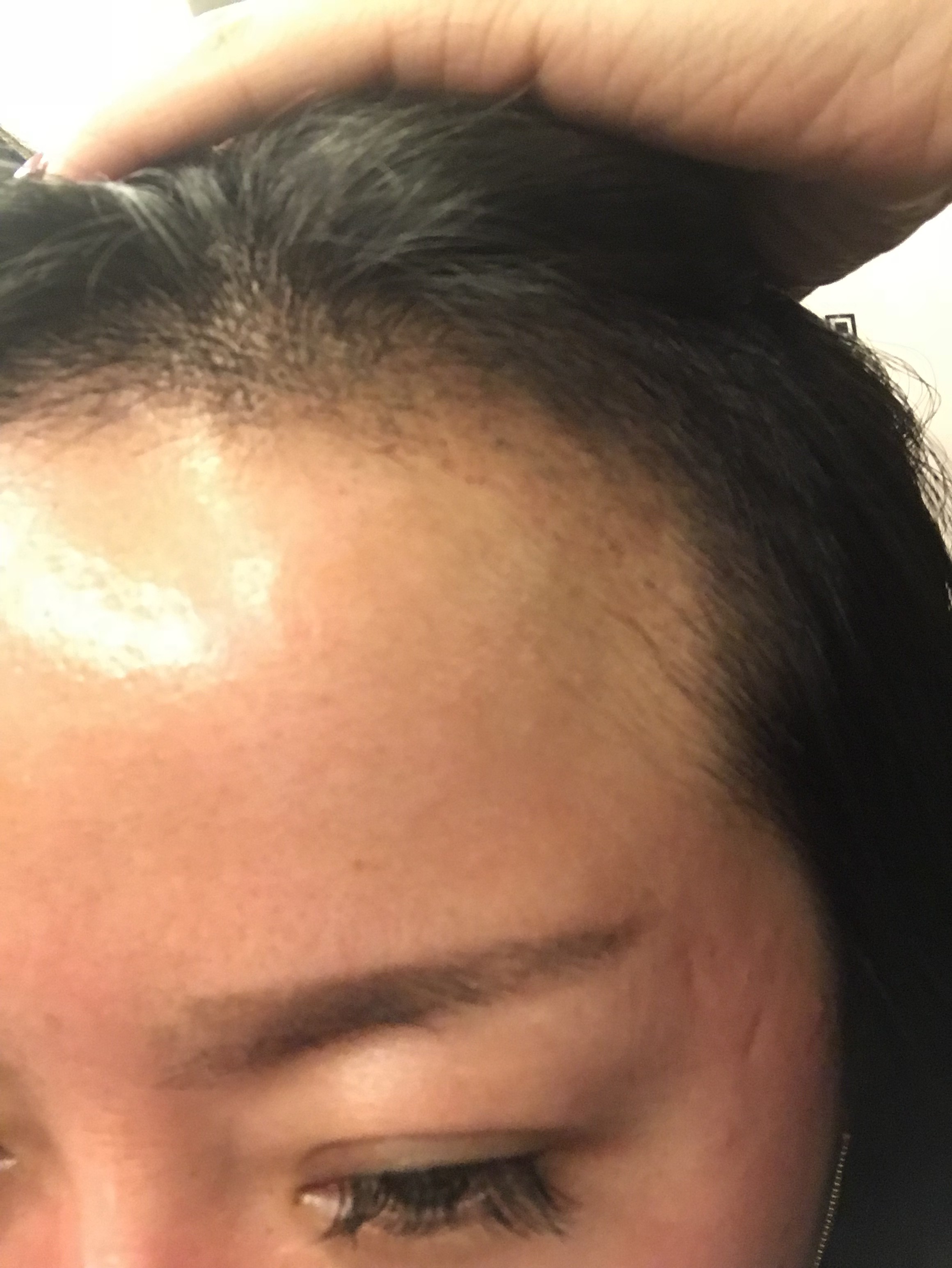 不剃发植发第20天,终于迎来脱落期