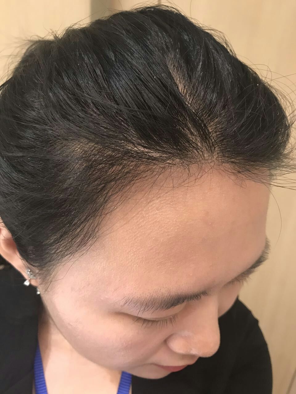 不剃发植发5个月啦,发际线已成型!