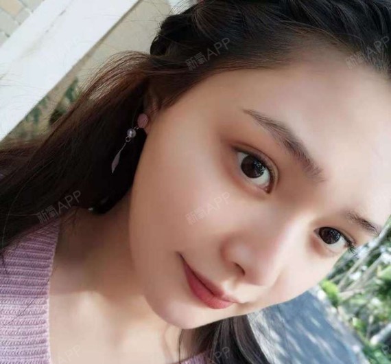 郑州内切去眼袋好不好_效果图_九玖丶内切去眼袋术后第63天_新氧美容