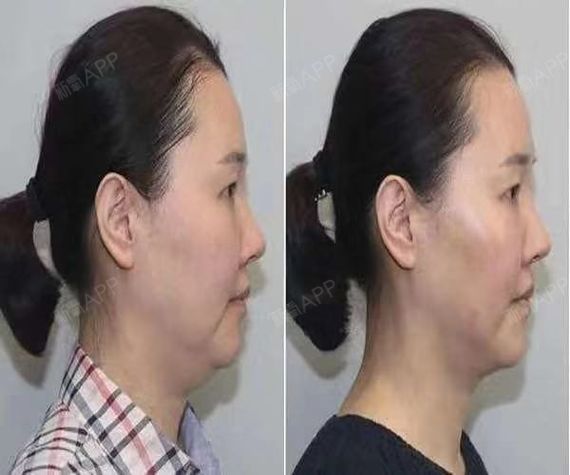 对比下颌缘吸脂和双下巴吸脂的侧面前后照片,下巴线条变化的很明显吧
