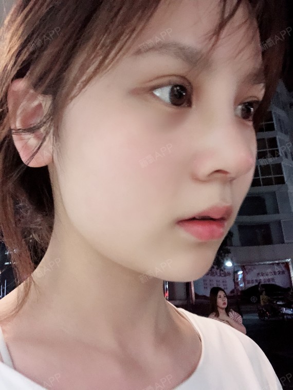 做鼻子到现在已经回归正常了,鼻子看起来有一点生硬但_圈子-新氧美容