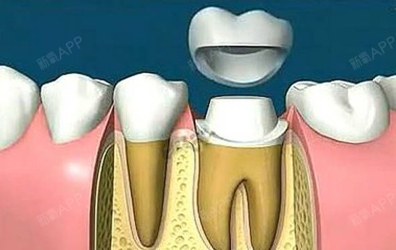所以 ,根管治療後的冠修復,就是在牙齒完整的基礎上,更省錢的一種方式