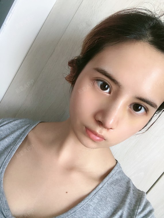 耳软骨复合隆鼻好不好_效果图_氧气zaa1086耳软骨复合隆鼻术后第7天