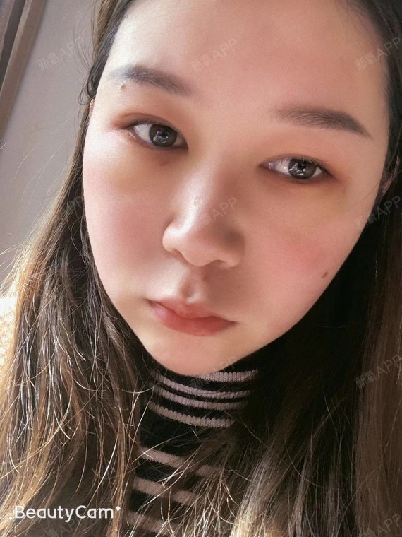 【芜湖瑞丽医疗美容 内吸祛眼袋 术后3天】眼袋去完_圈子-新氧美容